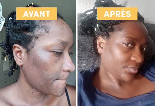 Macérat huileux de Busserole