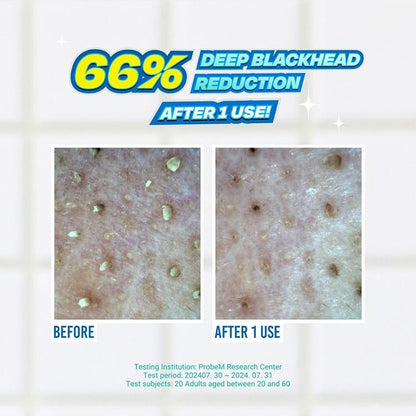 Blackhead Melting Softener